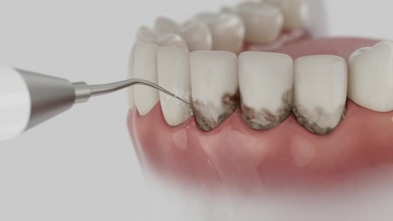 Reliable Tooth Extraction contractor in Navarre, OH by Smile Center Dentistry